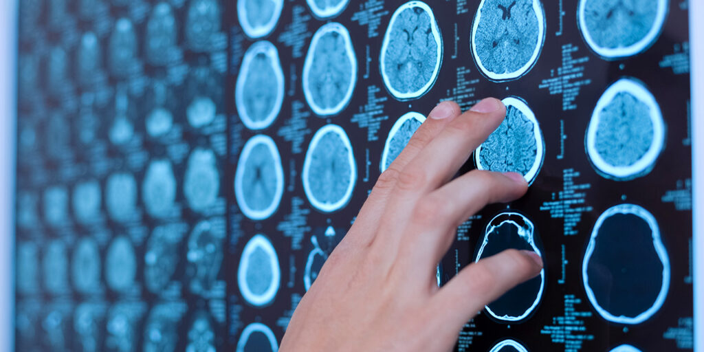 doctor pointing to mri results